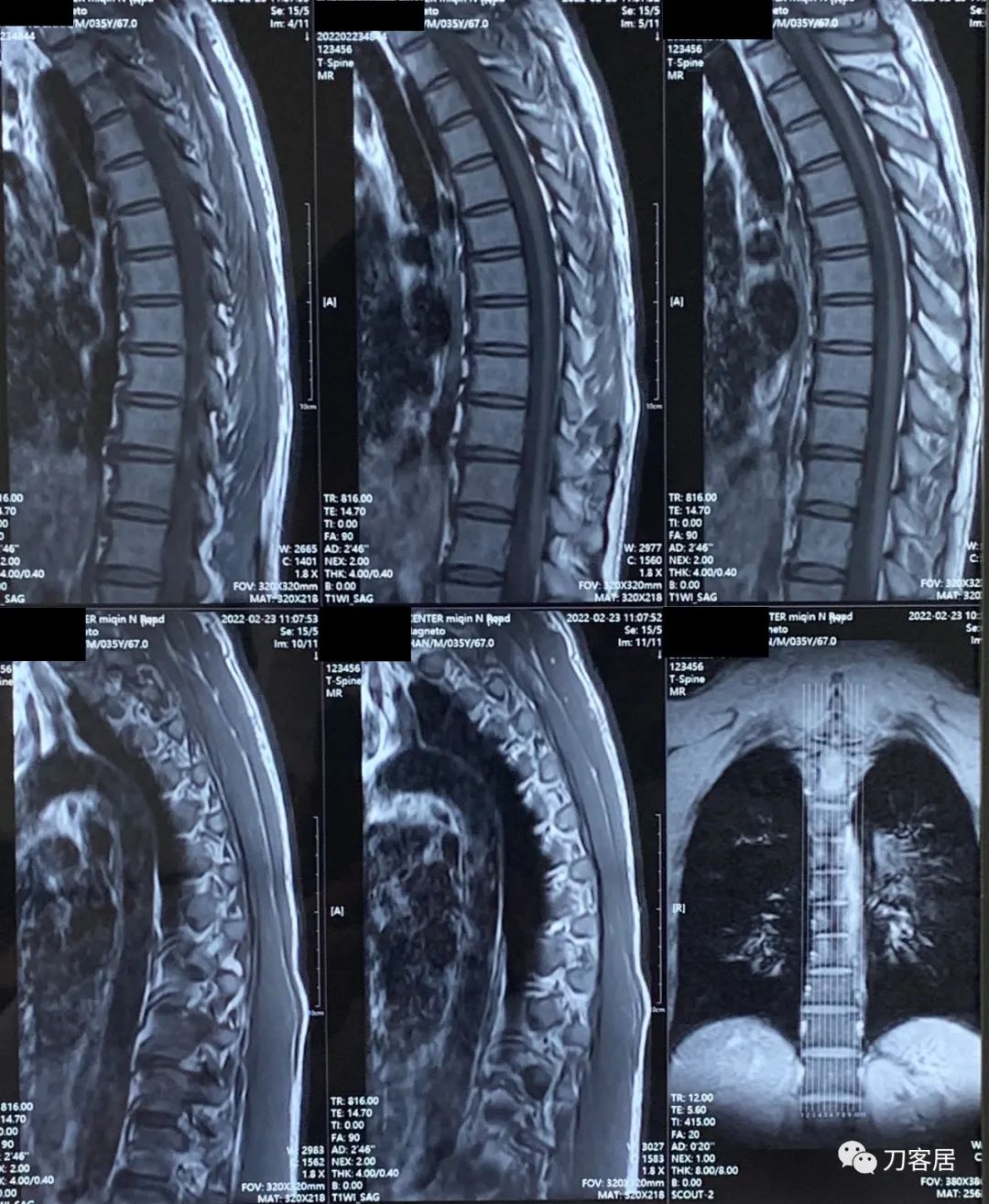 腰椎间盘突出压迫腿疼看神经内科,腰椎间盘突出看骨科还是神经内科