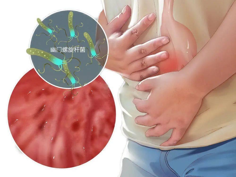 胃窦炎反酸烧心怎么办,胃窦炎引起胃胀疼吃什么药