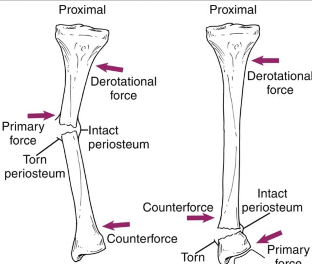 第一掌骨基底部骨折手法复位,骨折手法复位原理