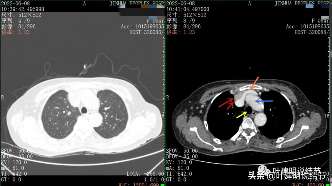 这位老乡，乏力来查，查出这么大个的纵隔肿瘤！会是什么呢？