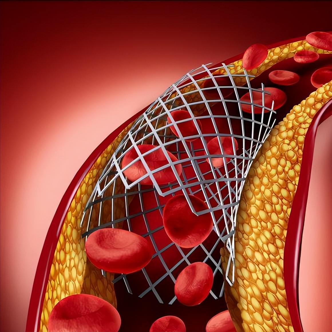 心脏支架对人体有什么危害吗,心脏支架对身体健康有危害吗