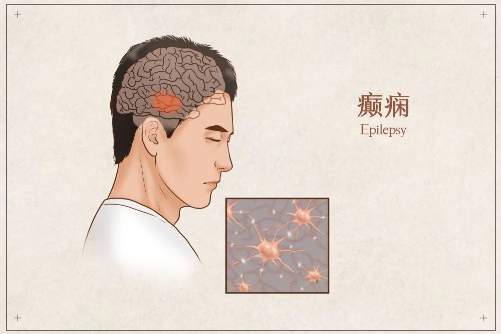 成年人预防癫痫要牢记的3点知识,怎么预防癫痫发作最有效
