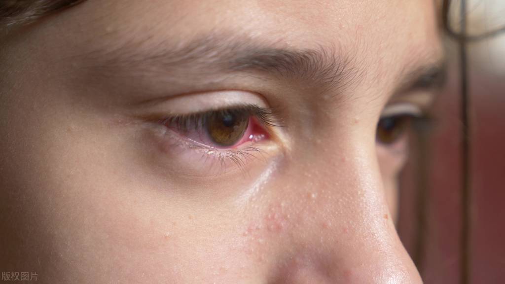 鼻窦炎会引起结膜炎,结膜炎是如何引起的会传染人吗