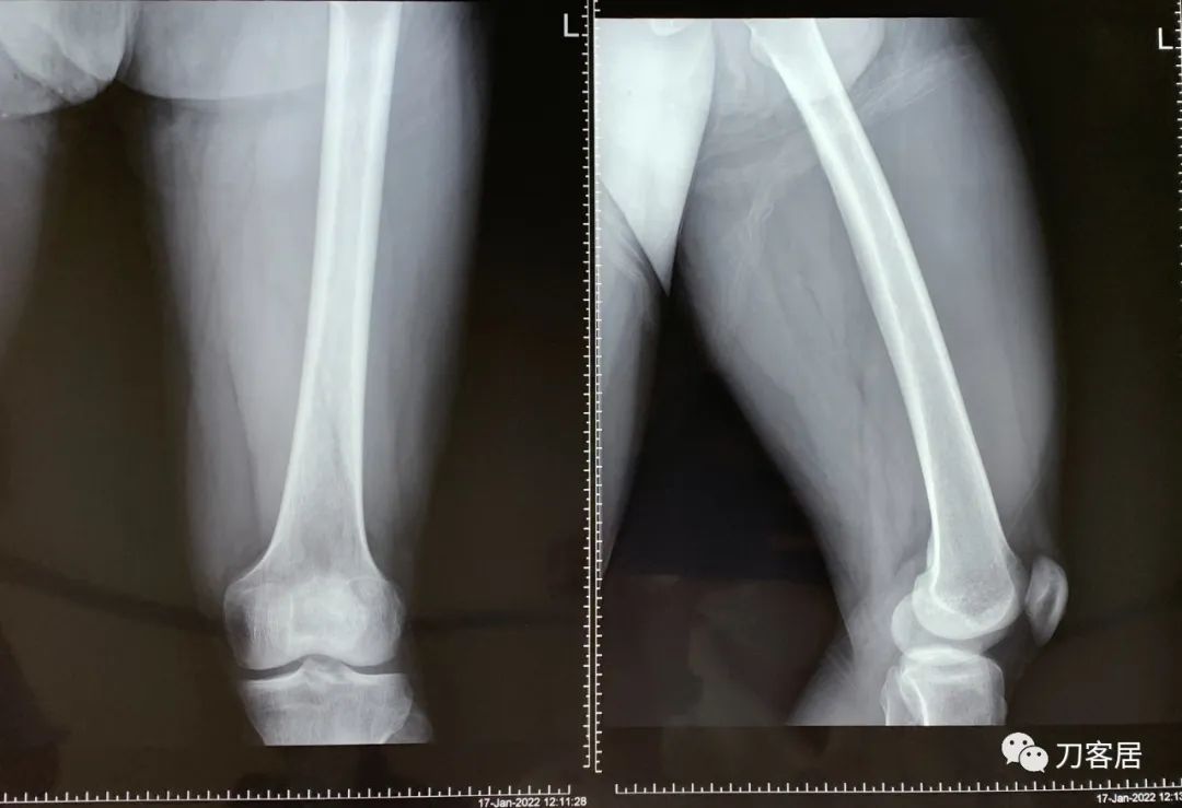 20岁腰5骶1椎间盘突出怎么办,腰5骶1椎间盘突出急性发作