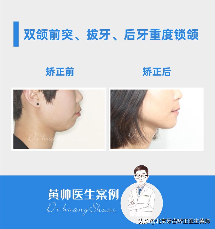 嘴凸的人怎么笑起来好看,嘴凸怎么让自己不焦虑