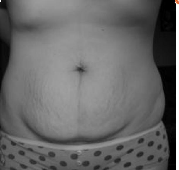 产后腹直肌恢复了肚子还突出,腹直肌分离肚子太松垮