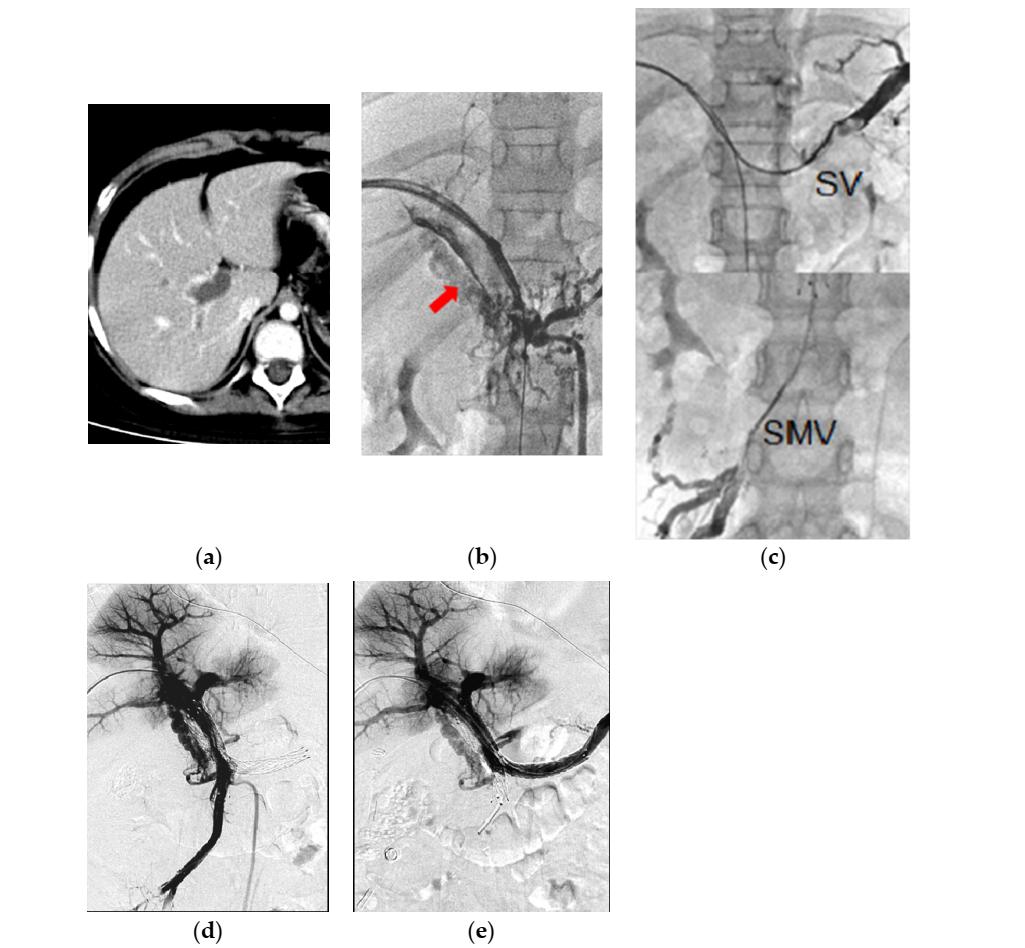 非肝硬化门静脉血栓,门静脉血栓溶栓治疗