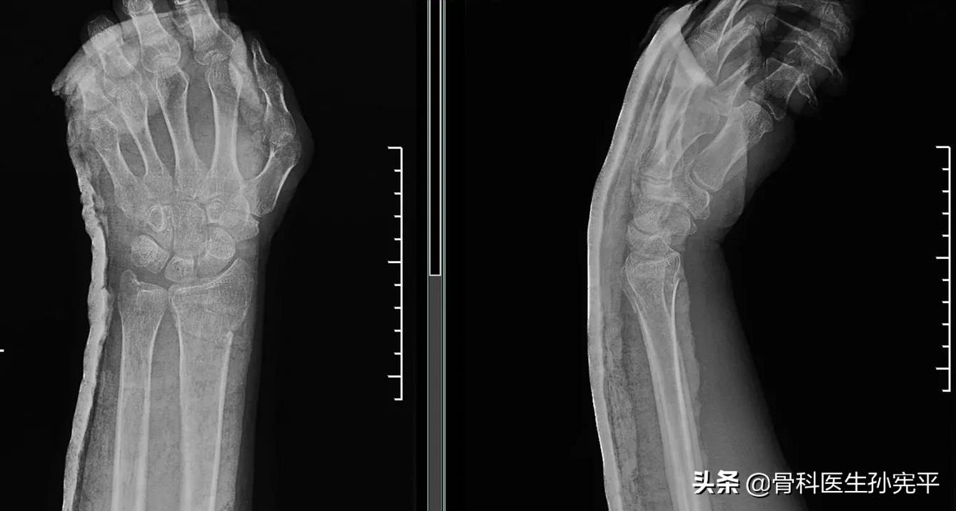 桡骨近端骨折和远端骨折哪个严重,桡骨远端骨折属于colles骨折吗