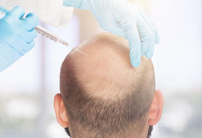 一个毛囊植发多少钱,植发不花冤枉钱在线了解植发价格