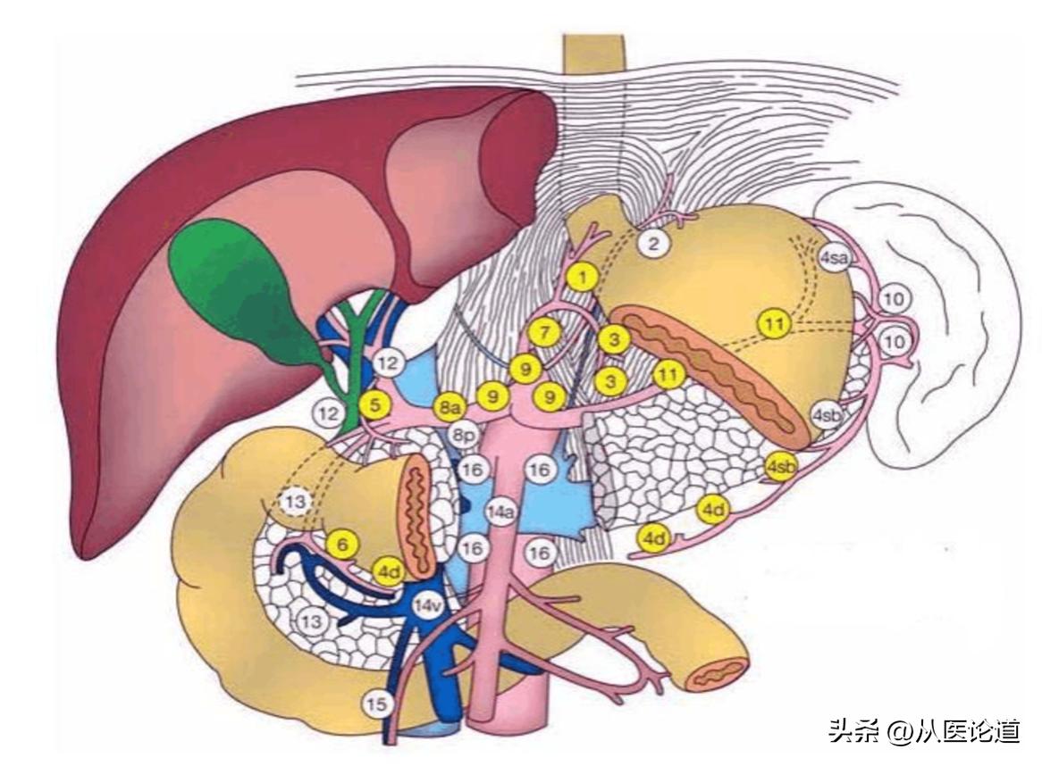 胃癌腹主动脉淋巴转移,胃癌及腹膜后淋巴转移