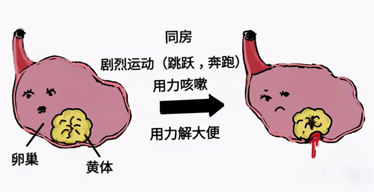 女明星黄体破裂什么原因,绝经的女人黄体会破裂吗