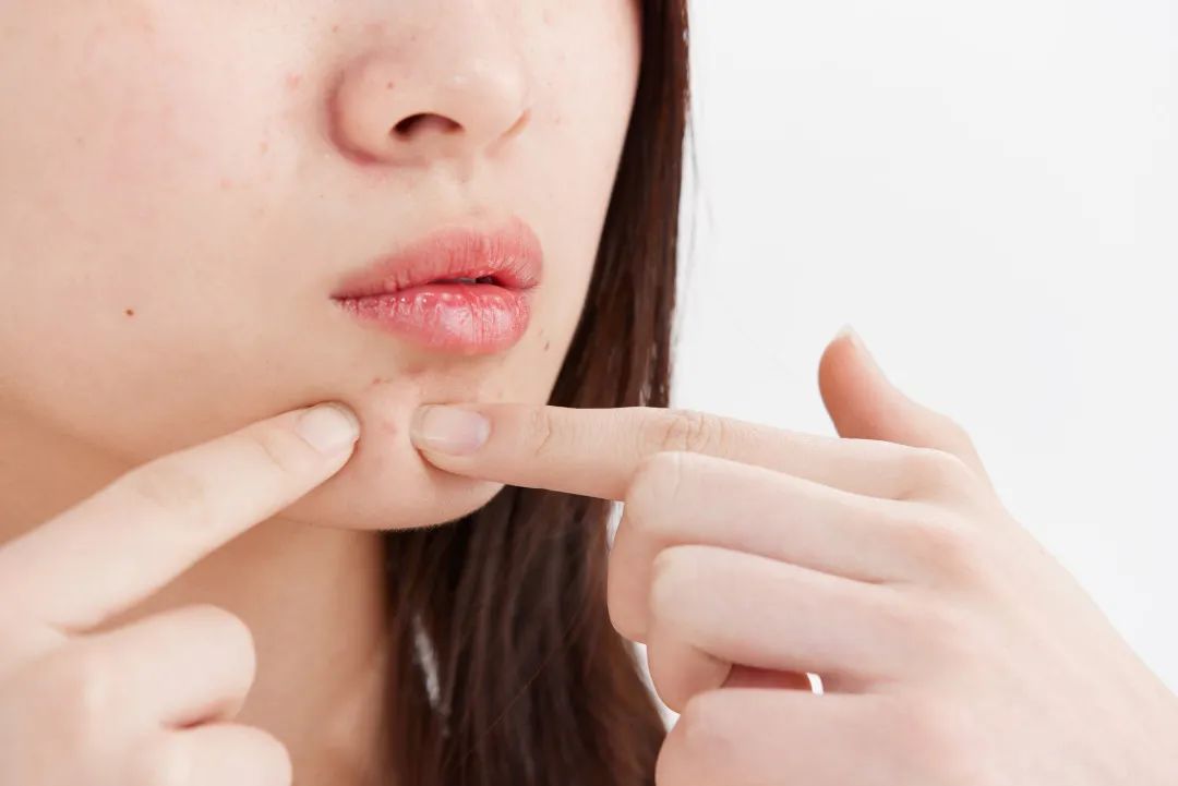 便秘长痘怎么调理,便秘会长痘是什么原因