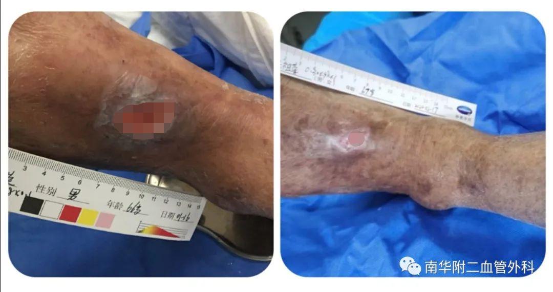 慢性创面治疗中心,创面治疗门诊