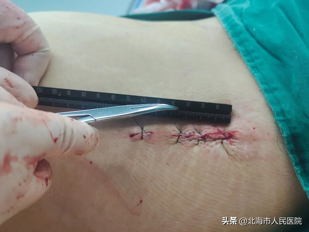 男子足球撞门柱,男子踢球被断球摔倒骨折