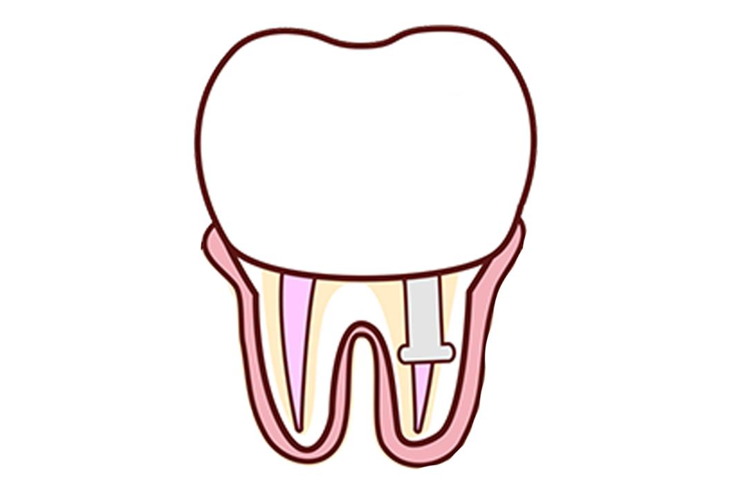如何让补过的牙用上好几年？