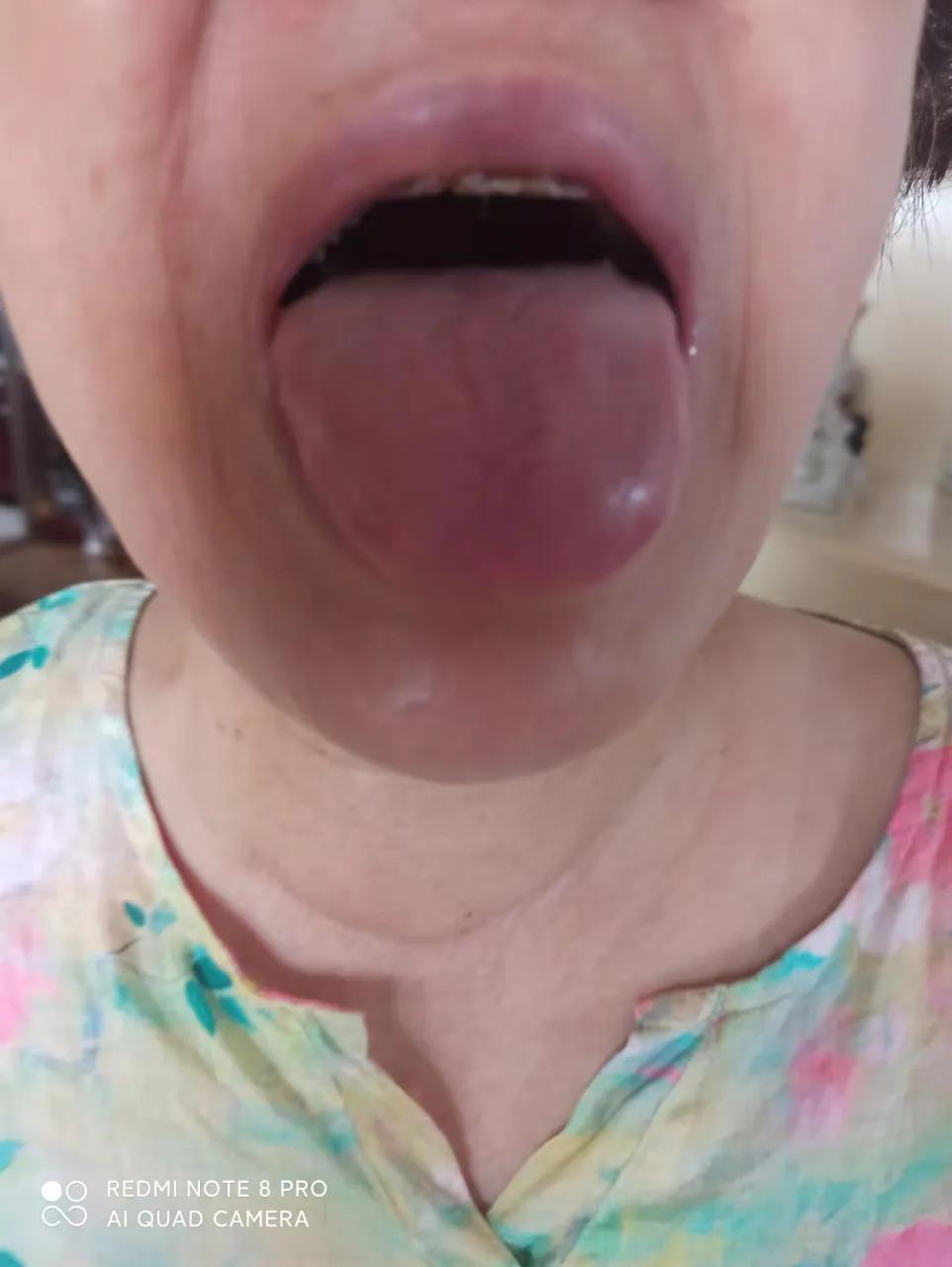 干燥综合征吃中药多久可以控制,干燥综合征喝中药可以治愈吗