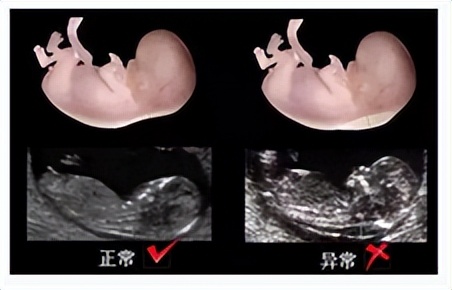 孕期最多能做几次b超,孕期需要做几次b超检查
