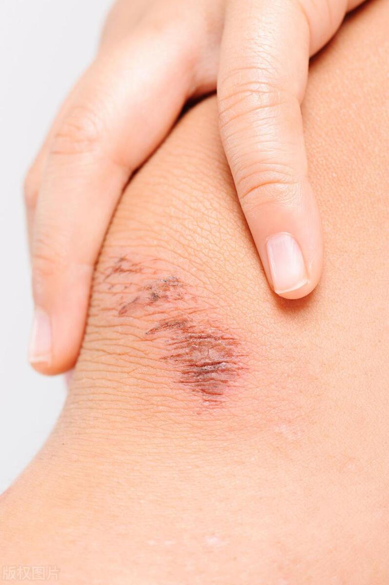 现在祛疤都有哪些方法图片,最有效的祛疤方法是什么