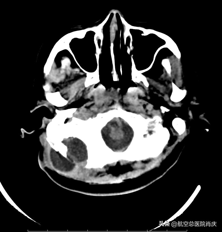 脑脊液漏修补丨脑干出血术后并发脑脊液漏，辗转求医终见希望