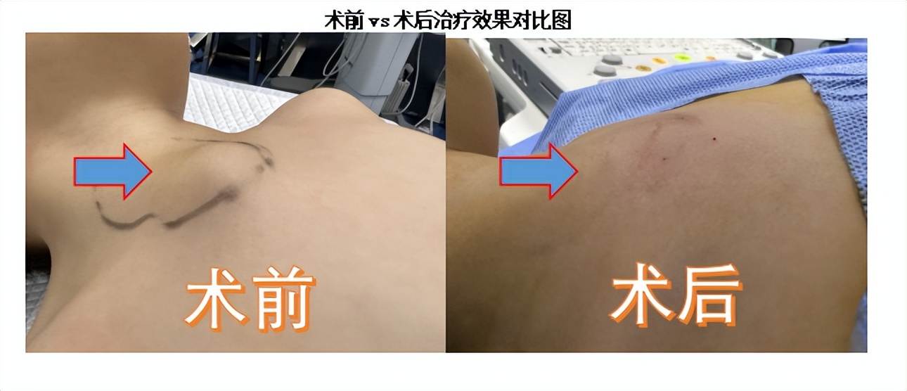 儿童腹部淋巴管瘤微创多久能下床,婴儿颈后淋巴管瘤介入治疗