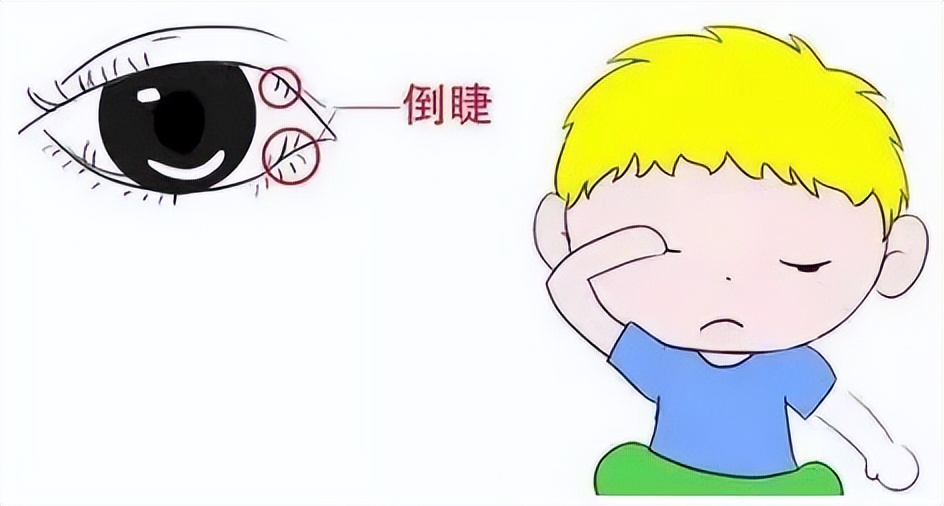 眼睫毛倒着长戳眼睛做手术多少钱,眼睫毛倒着长戳眼睛民间说法