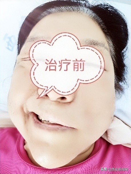 面瘫治疗三个月患侧脸变小了,重度面瘫恢复的征兆