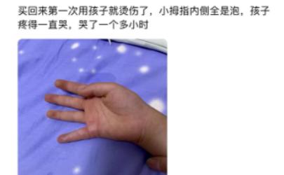 「网红玩具」爆炸！2岁孩子烧伤妈妈，快看看你家有吗？