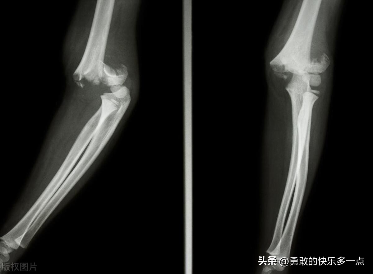 肱骨髁上骨折,肱骨髁上骨折图