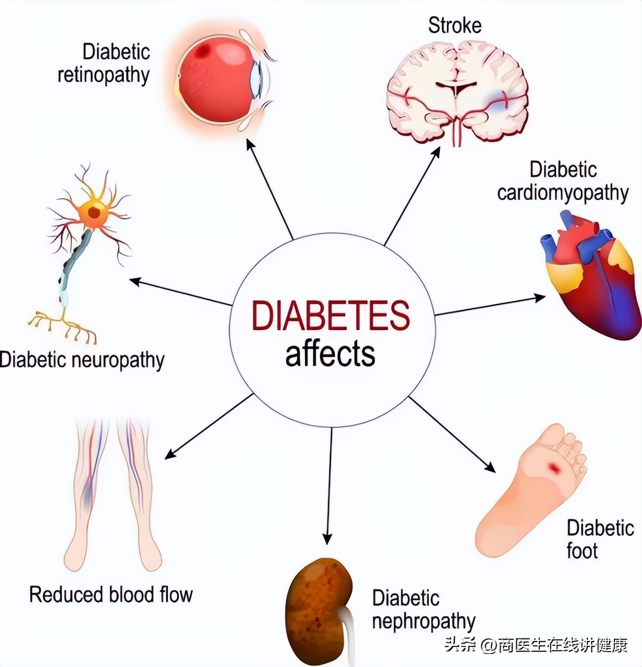 降糖药达格列净长期吃有什么害处,揭密降糖神药达格列净健康科普