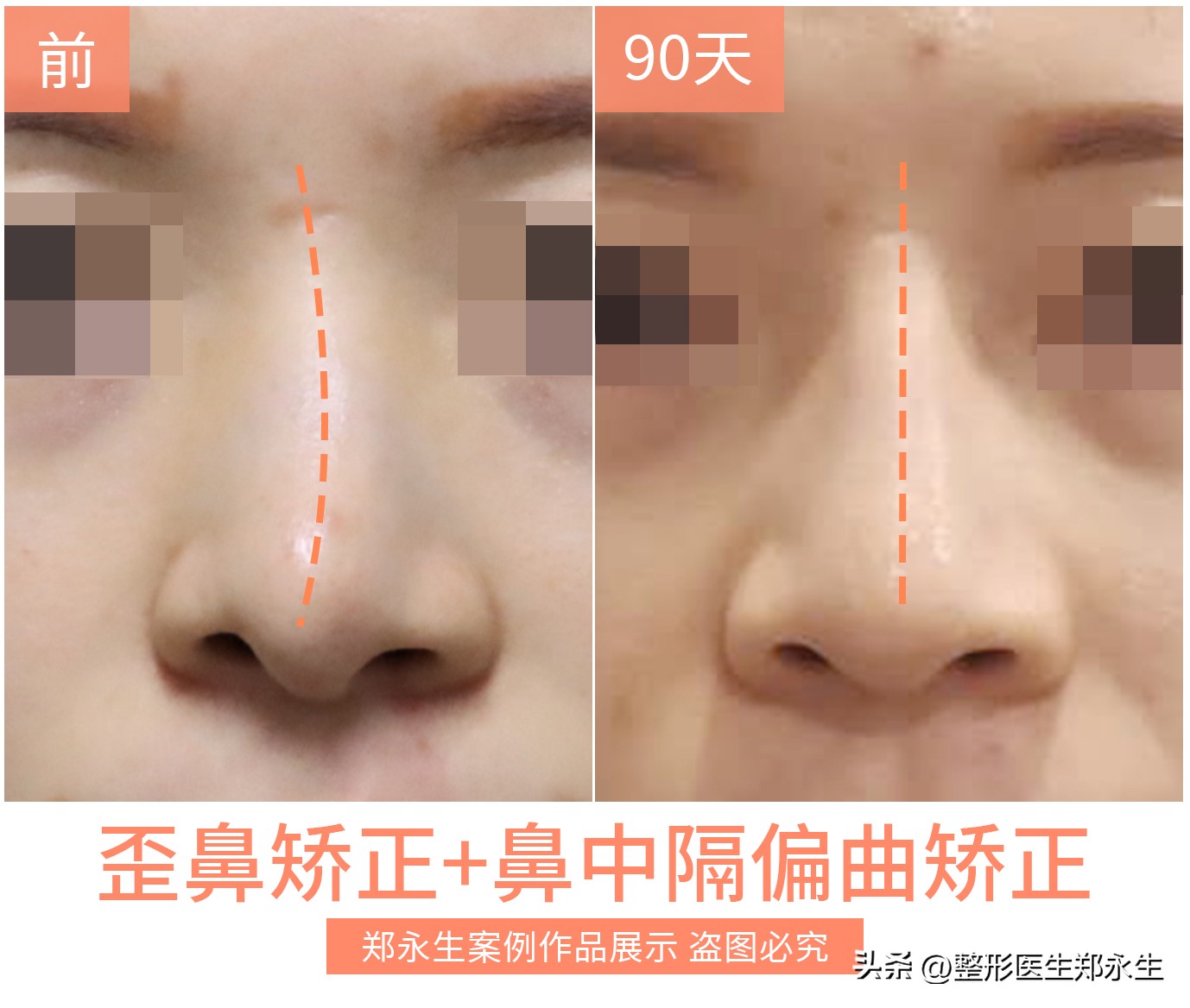 丑鼻子如何变成好看的鼻子,什么样的鼻子让人难看