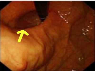 胃食管反流胸闷憋气打嗝怎么治,胸闷气短是胃胀还是食管反流