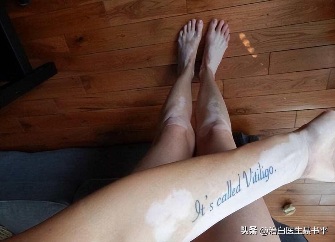 白癜风停止扩散纹身遮盖怎么样,女孩白癜风治好会再复发吗