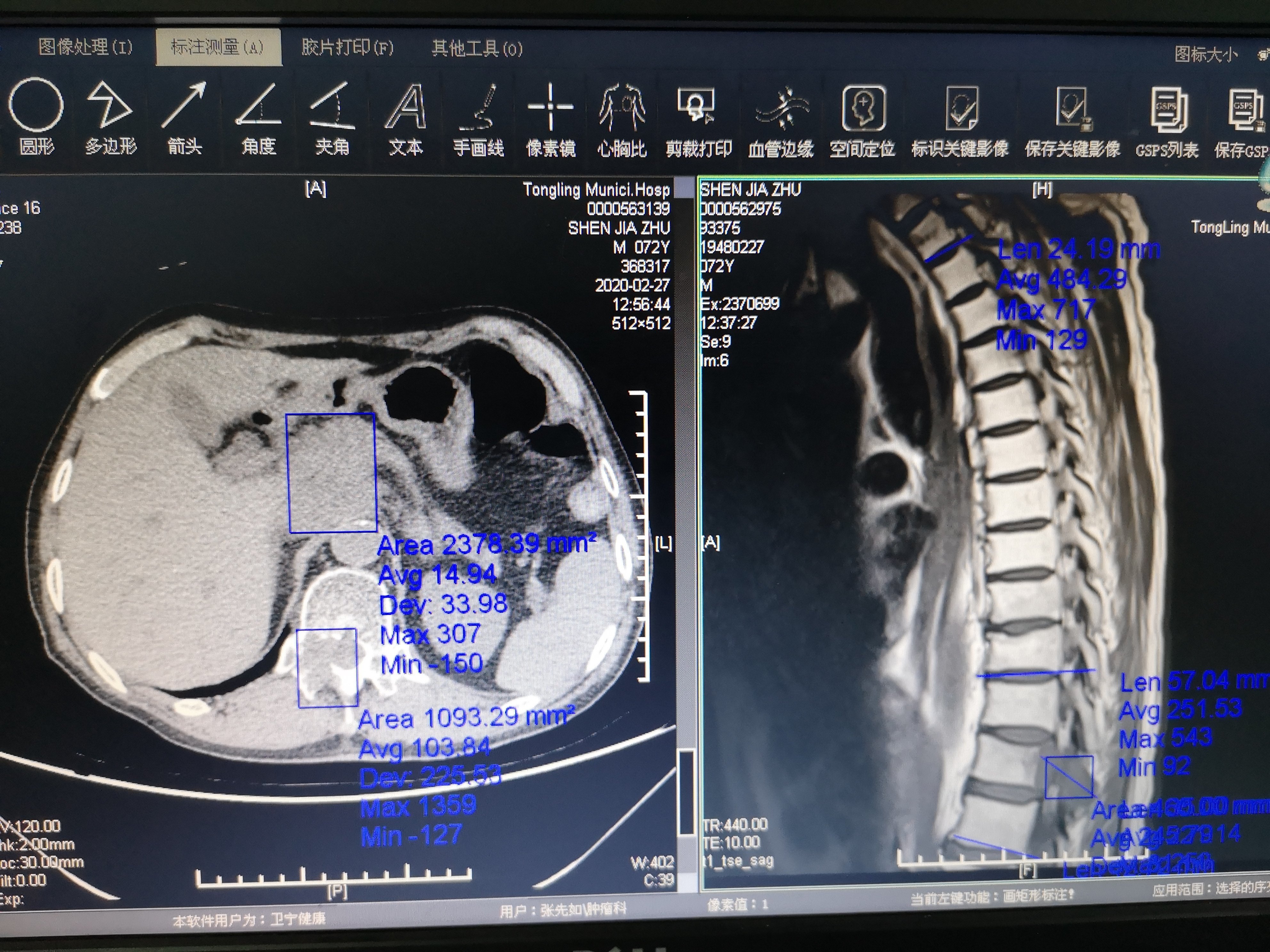 食管癌诊断金标准,食管癌诊疗规范2020电子版