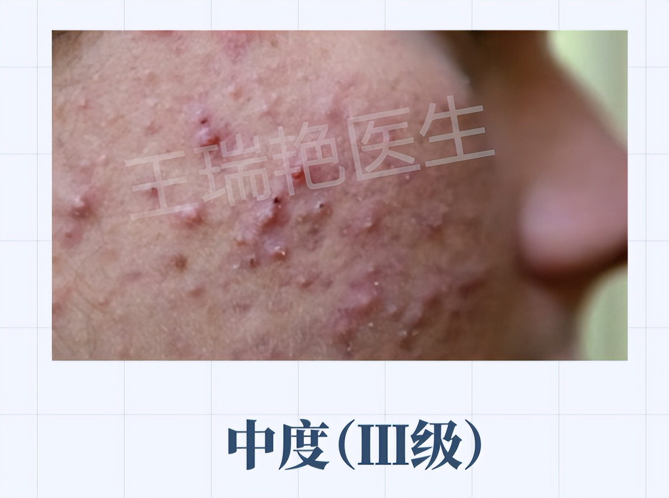 怎么区分不同种的痘痘,如何分清自己的痘痘是什么类型