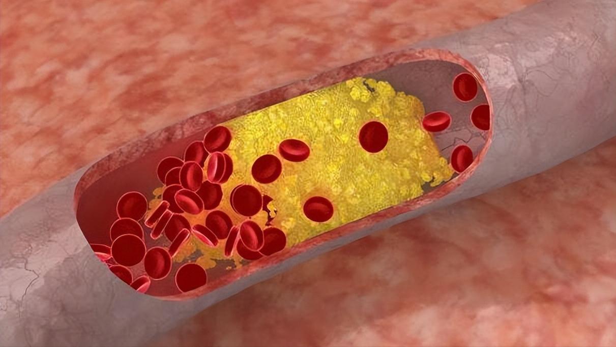 打什么针可以清理血液垃圾,老年人打清血针好不好