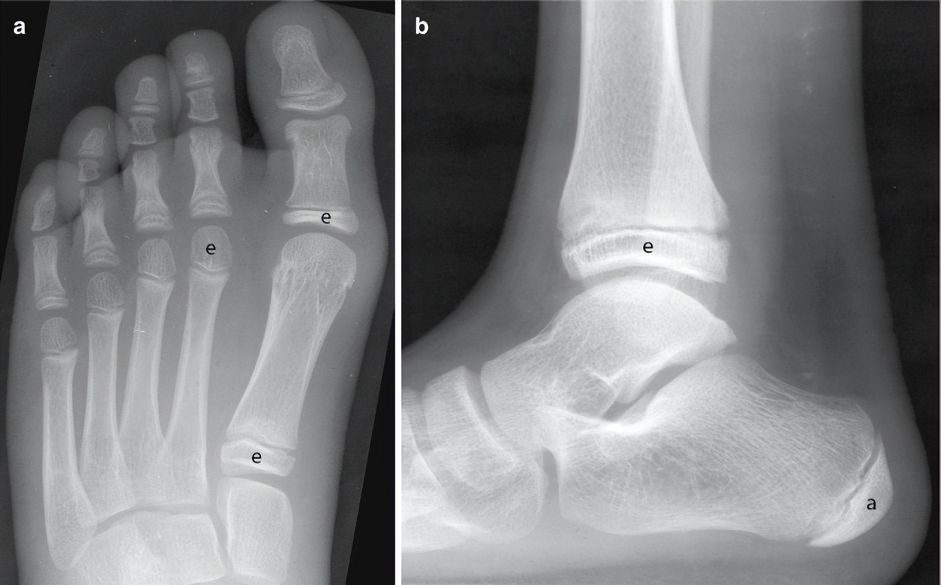 拇外翻几岁可以做手术,轻微拇外翻不好看可以手术吗