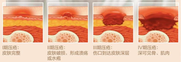压疮的表现有哪些,什么是压疮怎么治疗