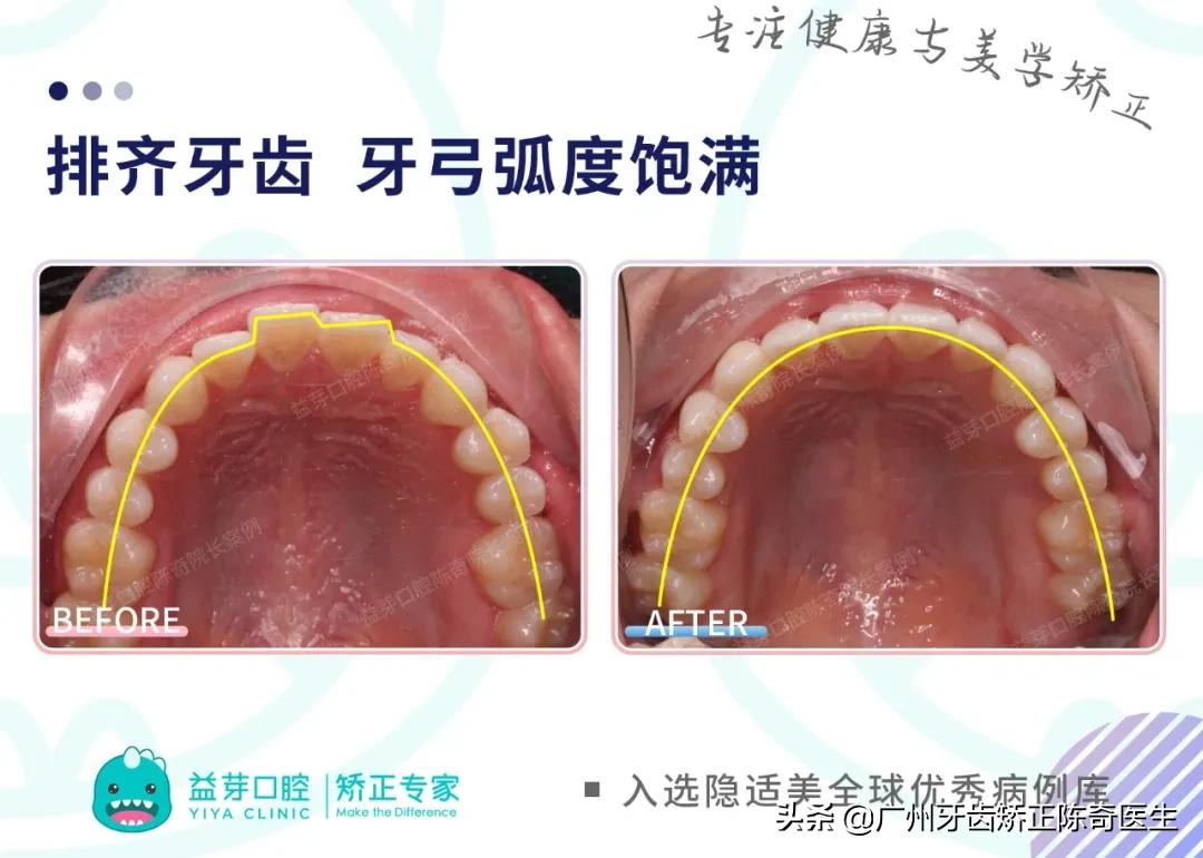 隐适美矫正和普通矫正的区别,隐适美矫正有几种版本
