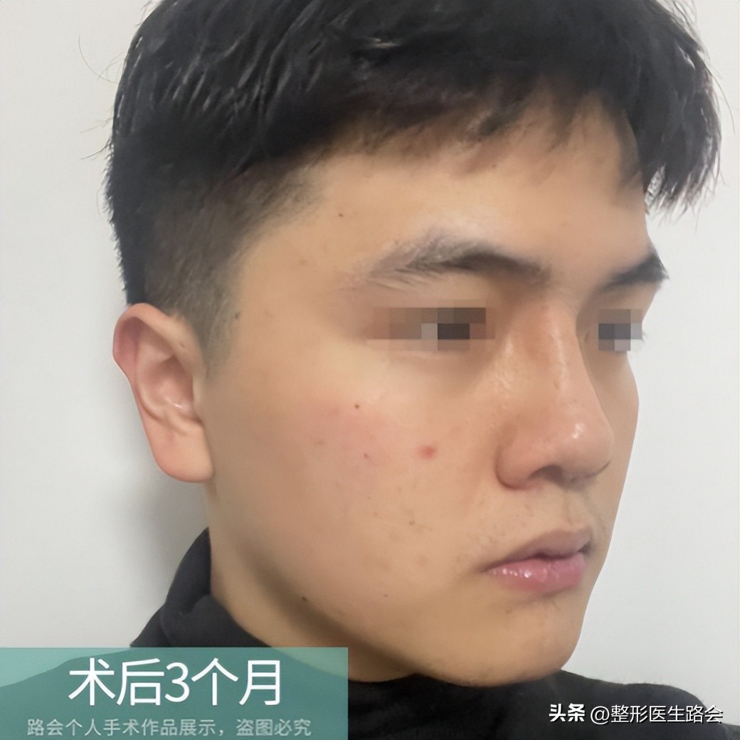 花了几万块钱做的鼻子,花上百万做鼻子