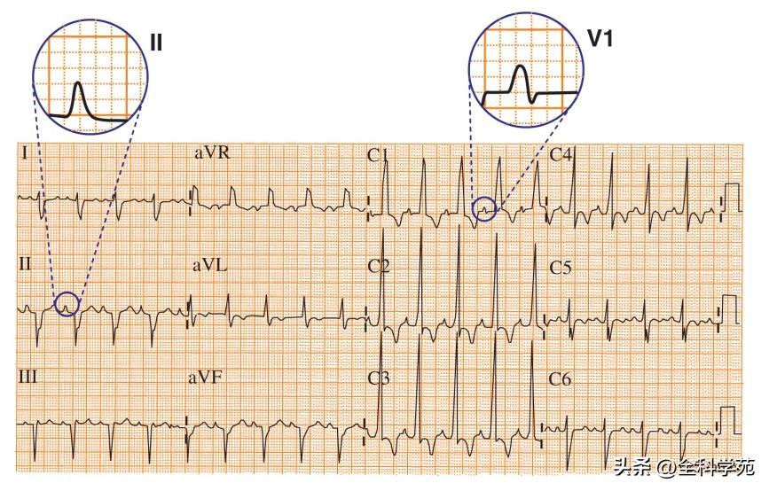 心电图分析窦性心律1100正常吗,心电图p波为窦性怎么看