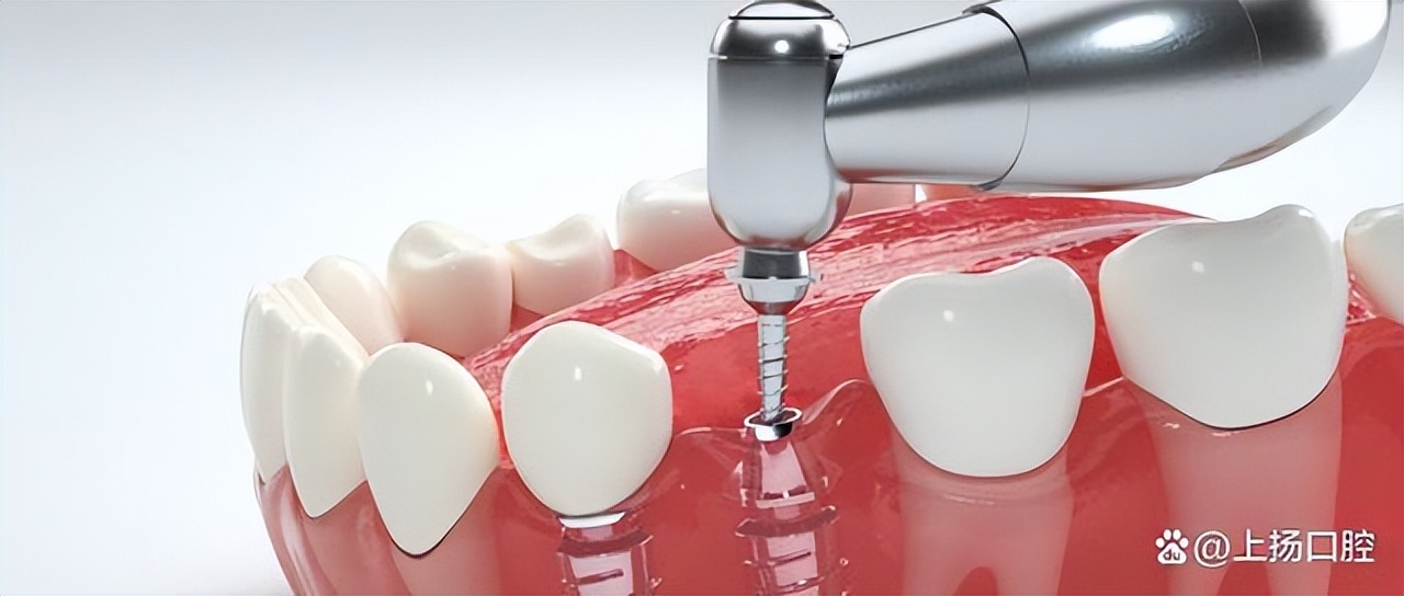 牙齿种植体系推荐,牙齿种植体哪个牌子比较好