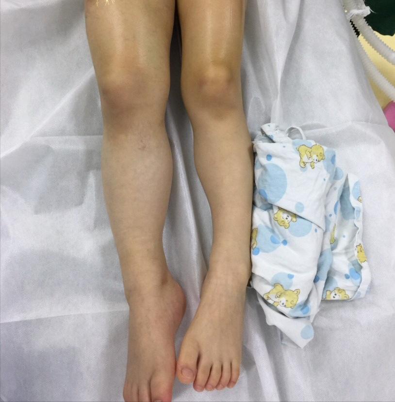 下肢静脉血管瘤,动静脉血管畸形微创介入