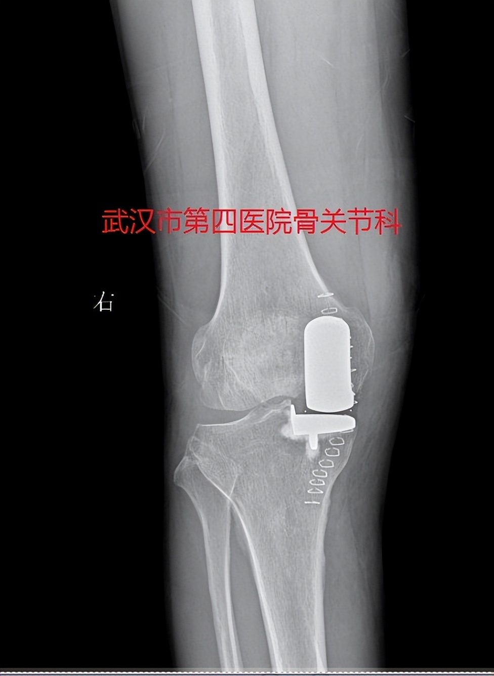 膝关节炎阶梯治疗专家共识,了解膝关节炎的预防和治疗很关键