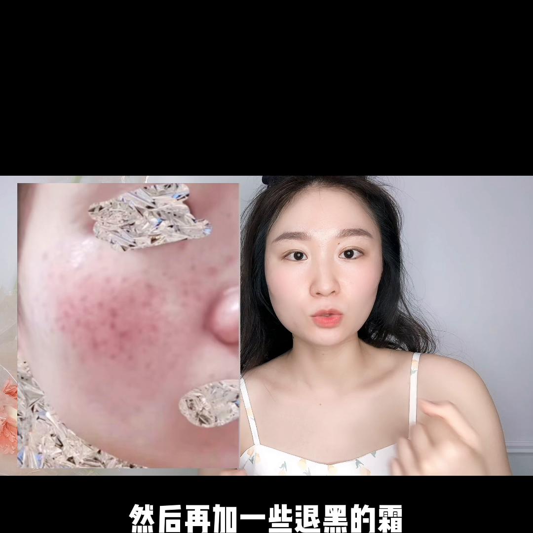 激光点痣掉痂后红印子可以护肤吗,点痣后的红印子可以正常护肤吗