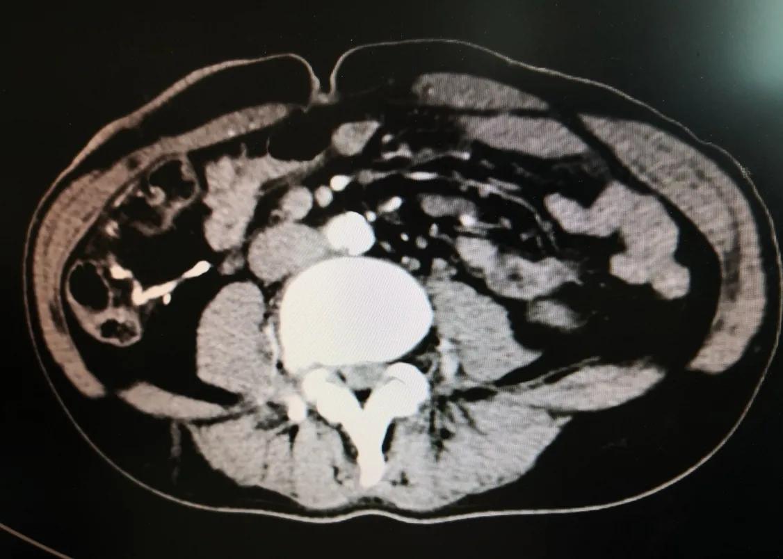 腹腔镜下结肠癌根治术,腹腔镜下结肠癌根治术手术步骤