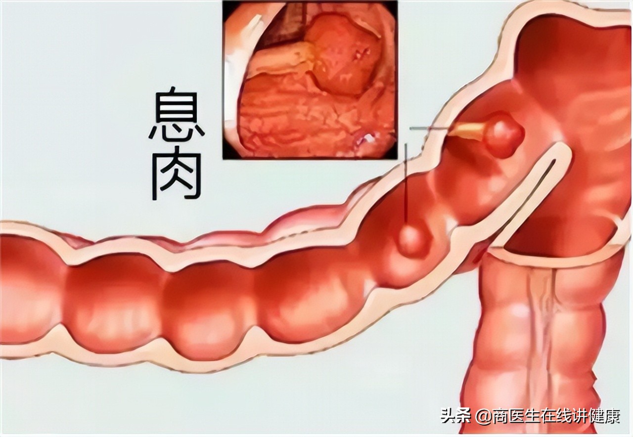 为什么肠道老是长息肉,为什么会有肠道息肉
