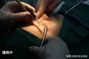 做双眼皮20天大小眼,做双眼皮二十几岁做最好