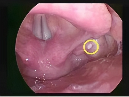 鱼刺卡喉求医6次,记录求医之路
