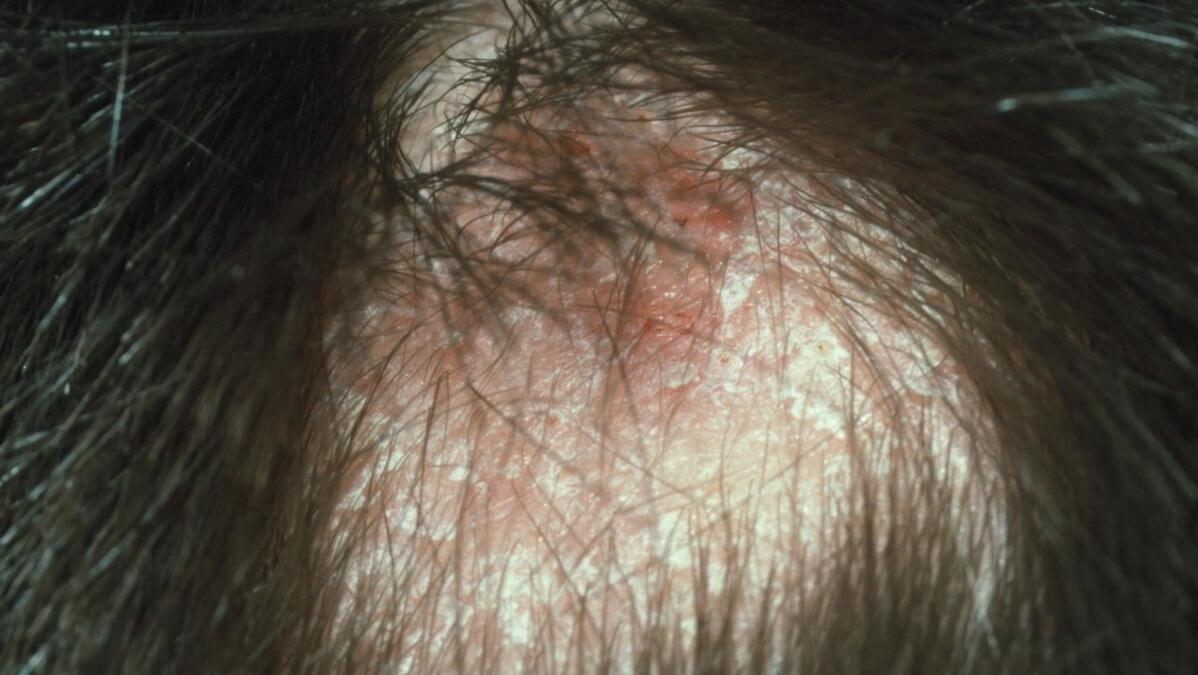 头皮屑多，真的是脑用过度吗？什么办法可以缓解？一次给你讲清楚