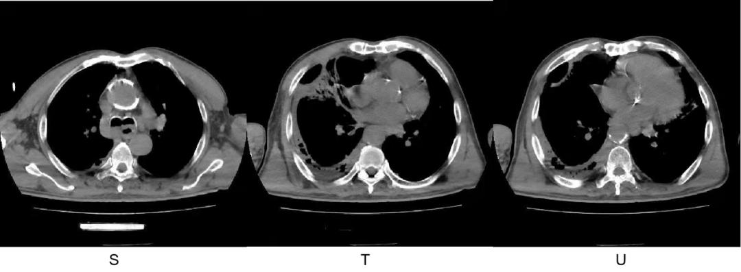 mrsa用什么药,mrsa对哪些药物敏感